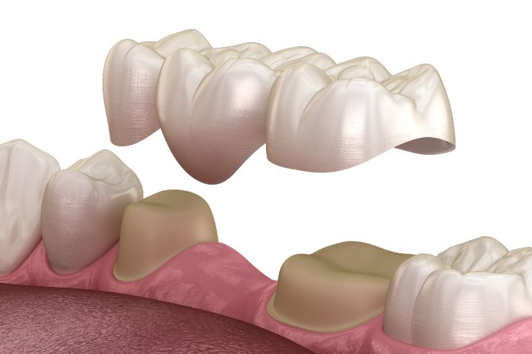 Dental Bridges