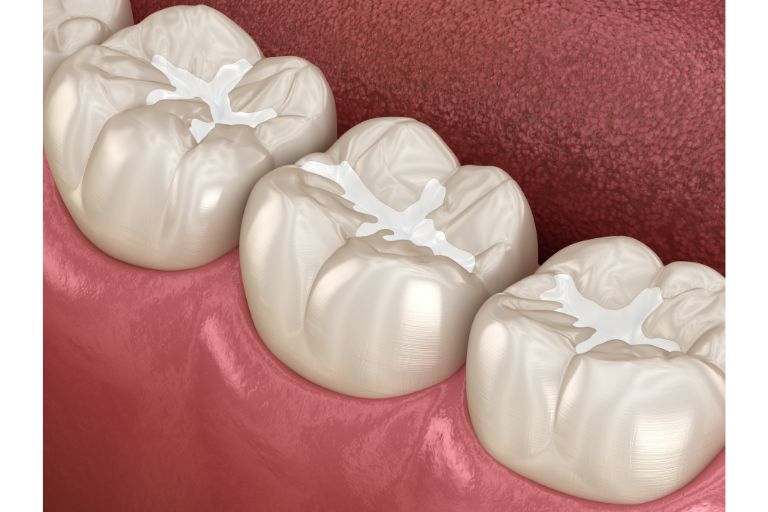 Dental Sealants