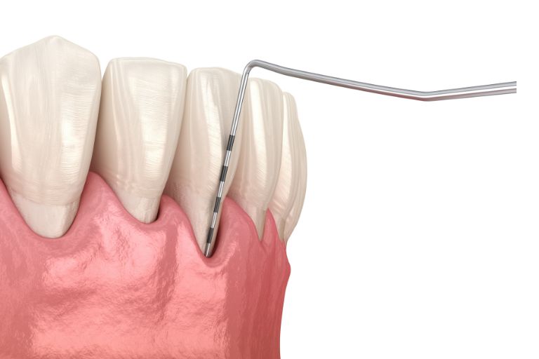 Periodontal maintenance