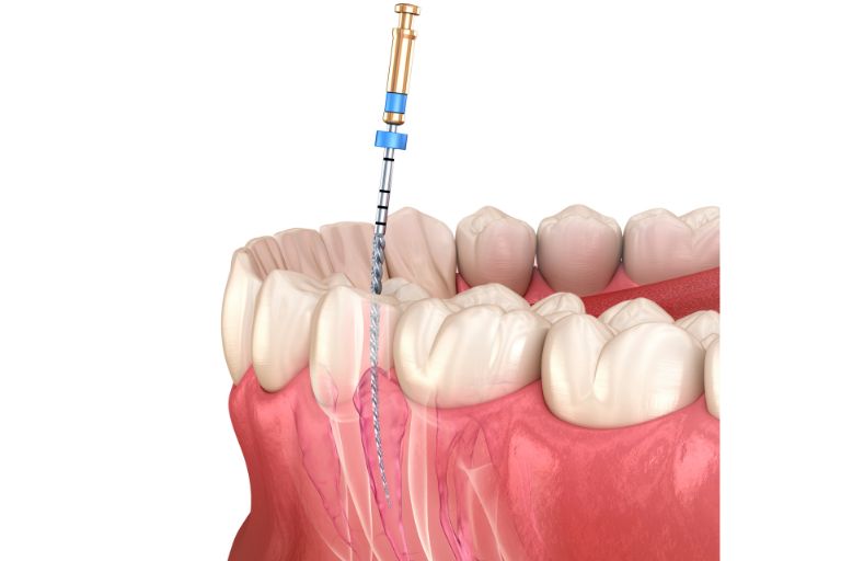 Root canal therapy