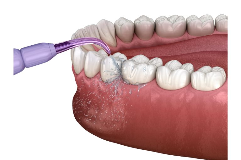 Routine cleaning for preventative care