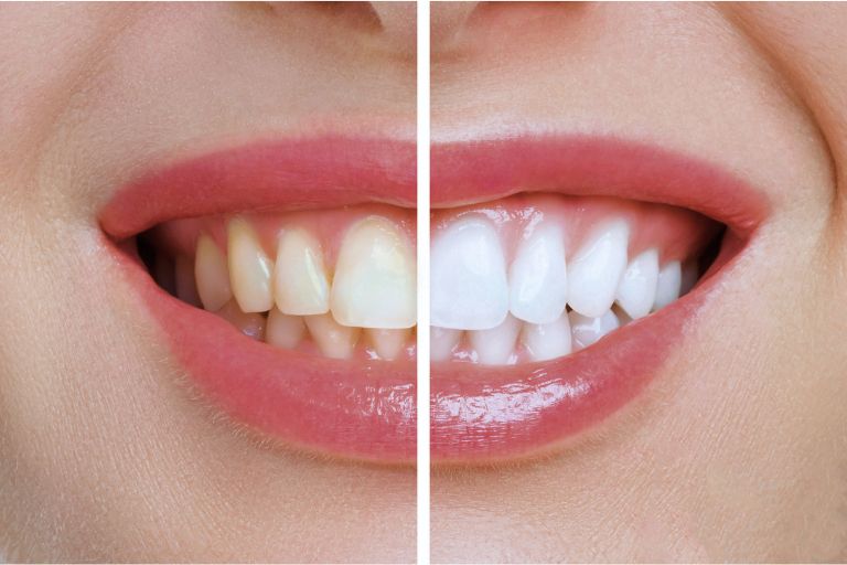 Teeth whitening