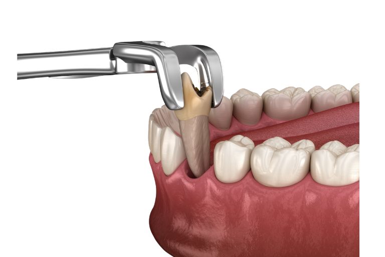 Tooth extractions