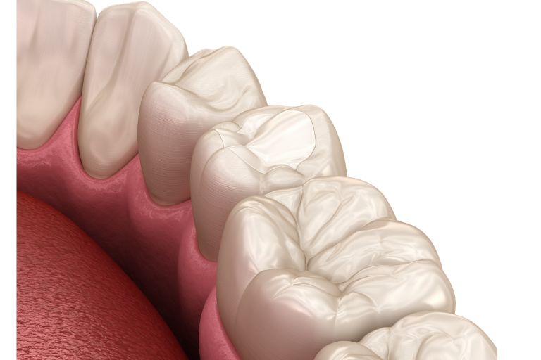 White fillings