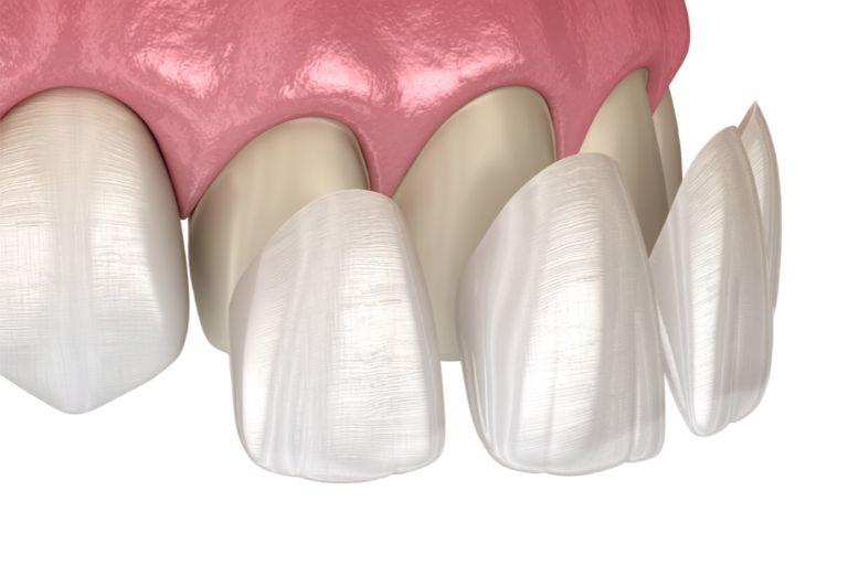 York Dental Veneers